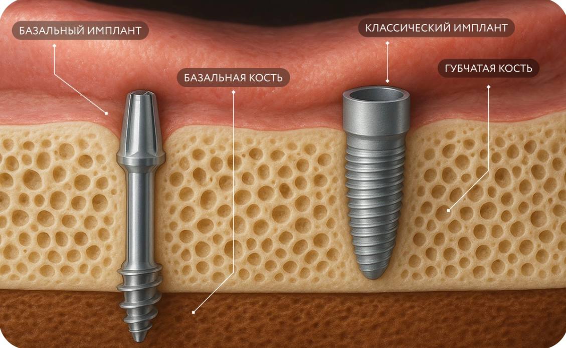 Базальная имплантация