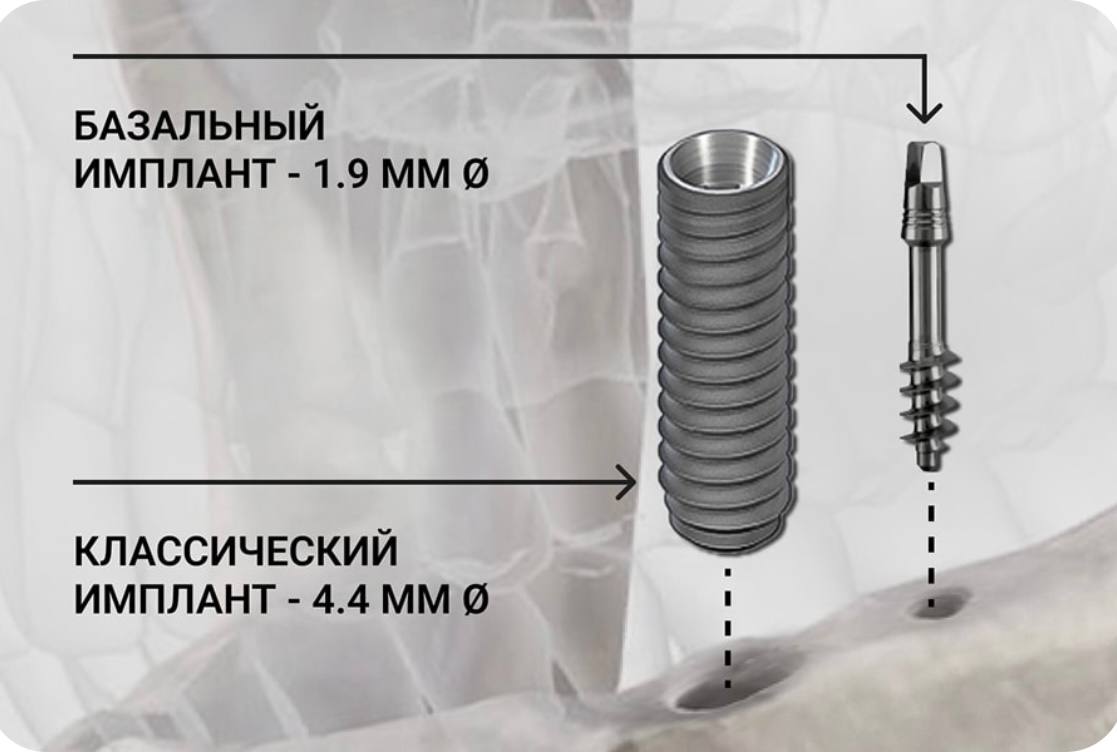 Базальная имплантация